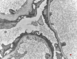 F,14y. | Alport syndrome - split and laminated, thick/thin basement membranes